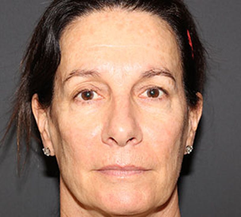 Browlift/Upper Blepharoplasty Before & After Gallery - Patient 106566624 - Image 1