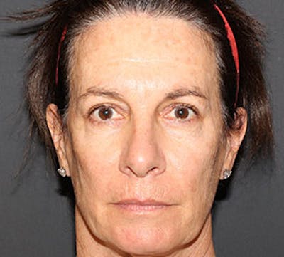 Browlift/Upper Blepharoplasty Before & After Gallery - Patient 106566624 - Image 2