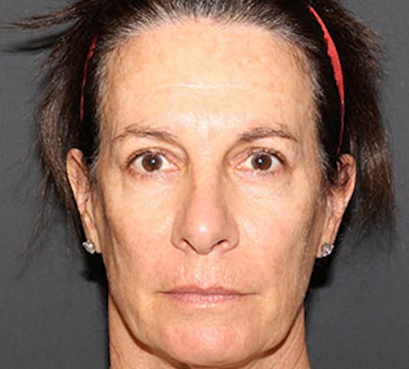Browlift/Upper Blepharoplasty Before & After Gallery - Patient 106566624 - Image 2