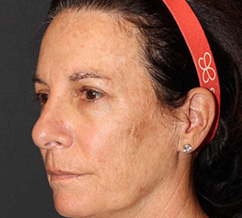 Browlift/Upper Blepharoplasty Before & After Gallery - Patient 106566624 - Image 8