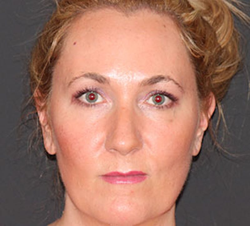 Browlift/Upper Blepharoplasty Before & After Gallery - Patient 106566628 - Image 2