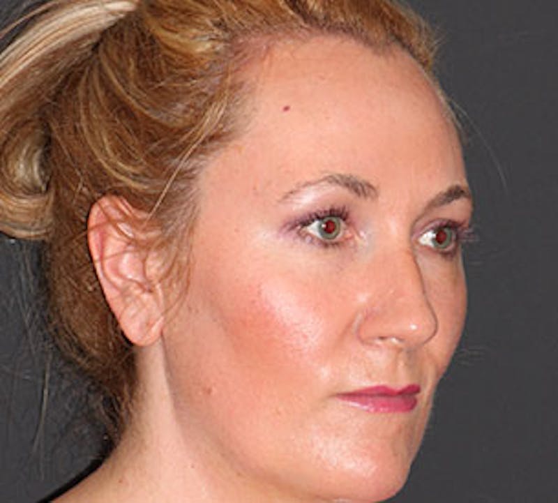 Browlift/Upper Blepharoplasty Before & After Gallery - Patient 106566628 - Image 4