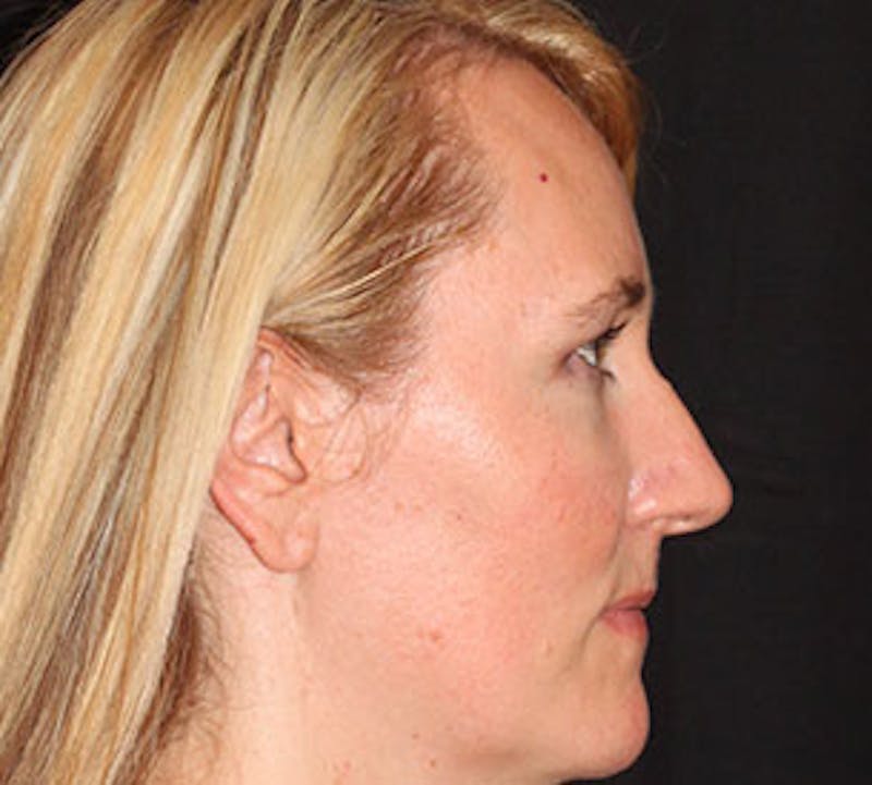 Browlift/Upper Blepharoplasty Before & After Gallery - Patient 106566628 - Image 7