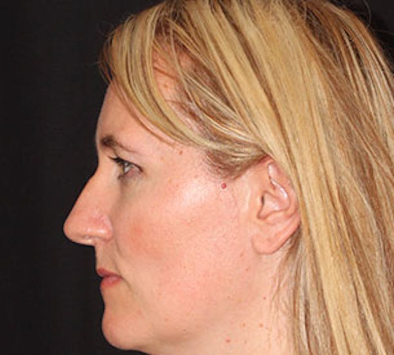 Browlift/Upper Blepharoplasty Before & After Gallery - Patient 106566628 - Image 9