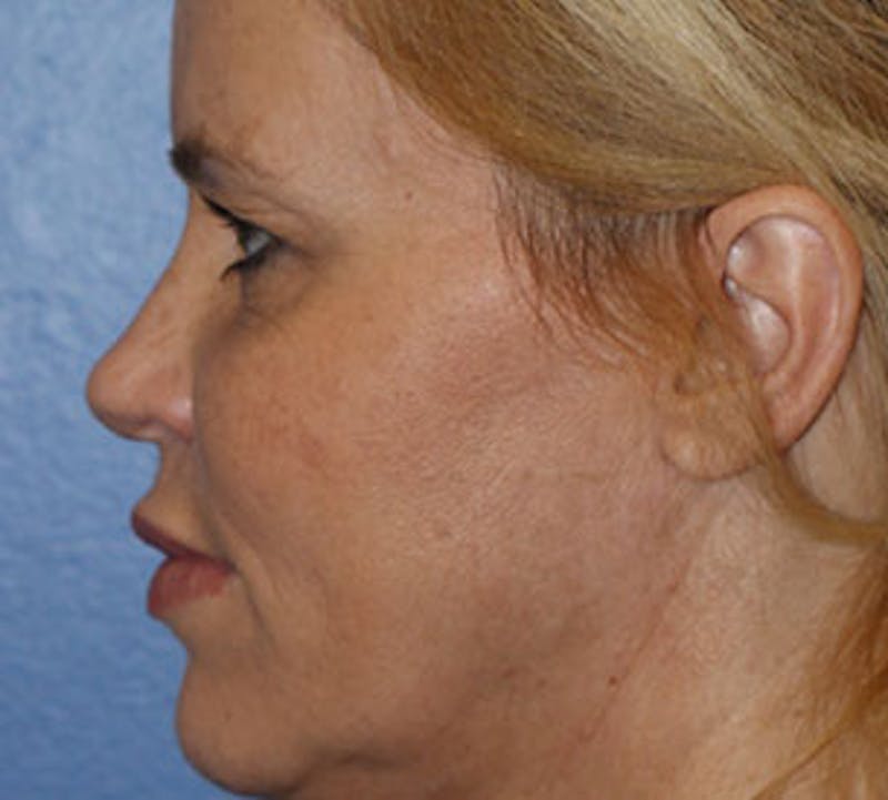 Browlift/Upper Blepharoplasty Before & After Gallery - Patient 106566631 - Image 9