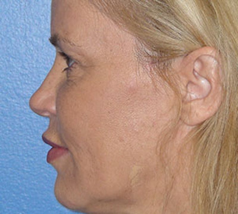 Browlift/Upper Blepharoplasty Before & After Gallery - Patient 106566631 - Image 10