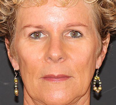 Browlift/Upper Blepharoplasty Before & After Gallery - Patient 106568812 - Image 2