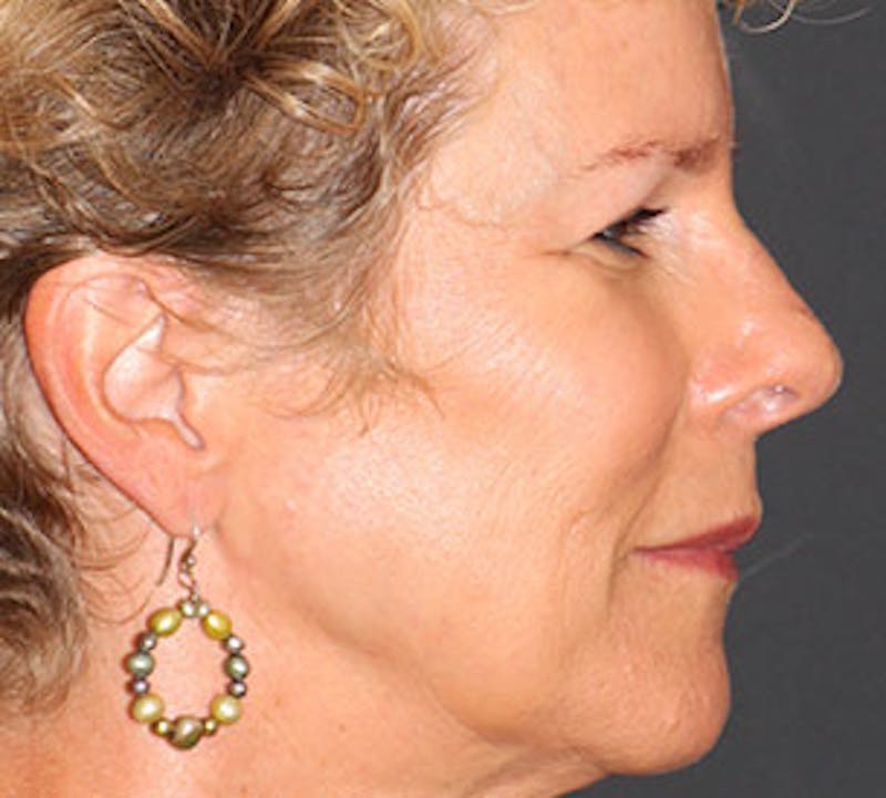 Browlift/Upper Blepharoplasty Before & After Gallery - Patient 106568812 - Image 8