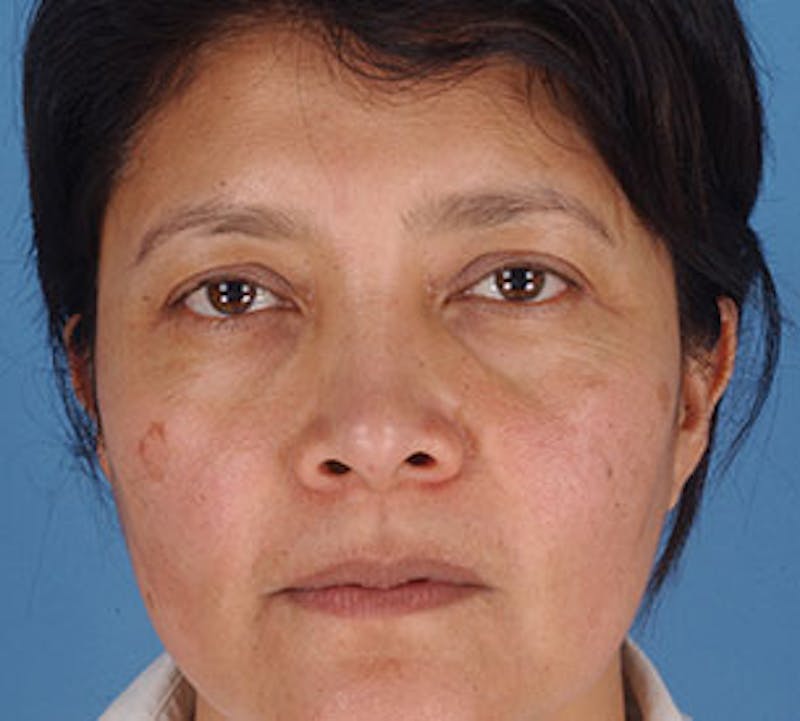 Browlift/Upper Blepharoplasty Before & After Gallery - Patient 106568821 - Image 1