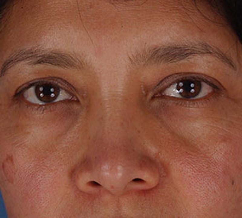 Browlift/Upper Blepharoplasty Before & After Gallery - Patient 106568821 - Image 3