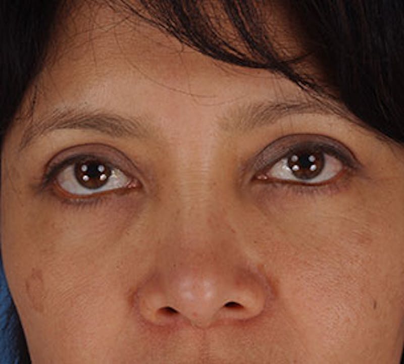 Browlift/Upper Blepharoplasty Before & After Gallery - Patient 106568821 - Image 4