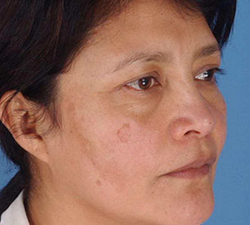 Browlift/Upper Blepharoplasty Before & After Gallery - Patient 106568821 - Image 5