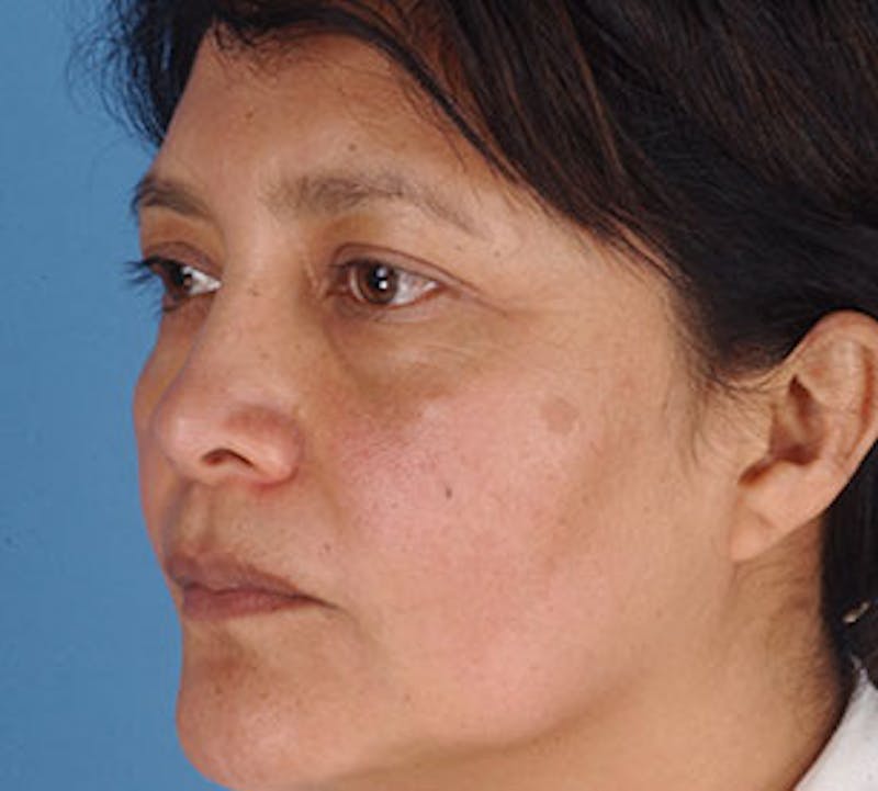Browlift/Upper Blepharoplasty Before & After Gallery - Patient 106568821 - Image 7
