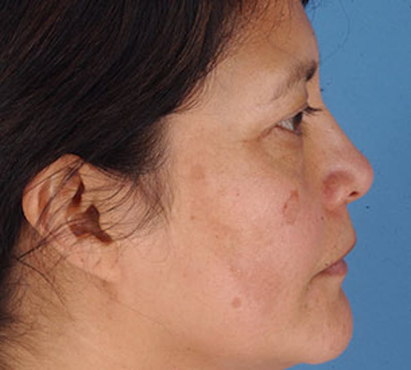 Browlift/Upper Blepharoplasty Before & After Gallery - Patient 106568821 - Image 9