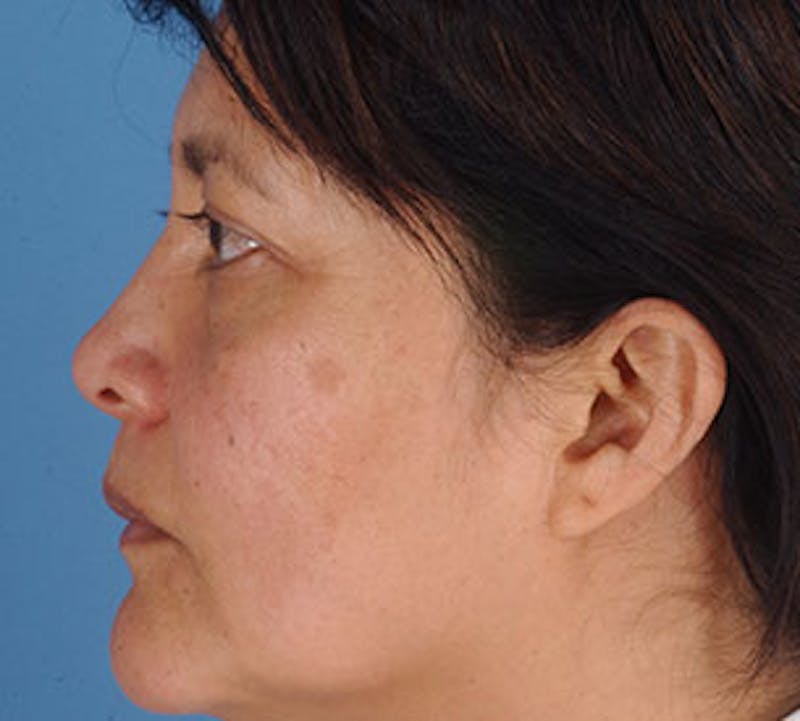 Browlift/Upper Blepharoplasty Before & After Gallery - Patient 106568821 - Image 11