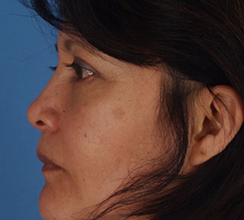 Browlift/Upper Blepharoplasty Before & After Gallery - Patient 106568821 - Image 12