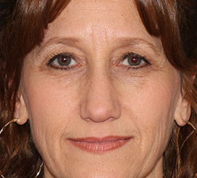 Browlift/Upper Blepharoplasty Before & After Gallery - Patient 106568823 - Image 1