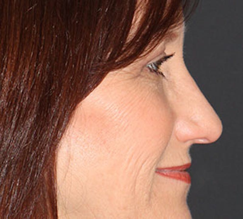 Browlift/Upper Blepharoplasty Before & After Gallery - Patient 106568823 - Image 8