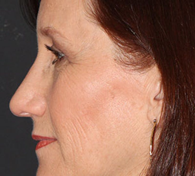 Browlift/Upper Blepharoplasty Before & After Gallery - Patient 106568823 - Image 10
