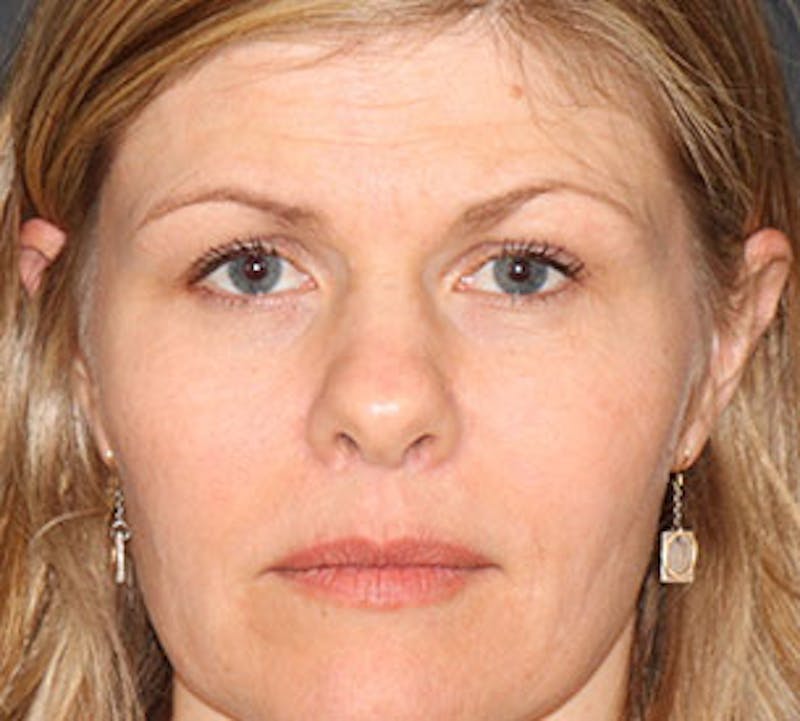 Browlift/Upper Blepharoplasty Before & After Gallery - Patient 106568843 - Image 1