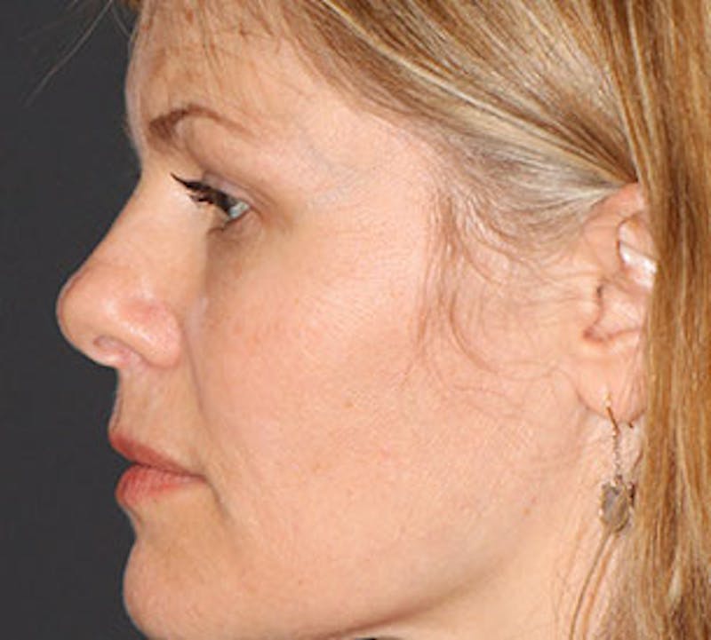 Browlift/Upper Blepharoplasty Before & After Gallery - Patient 106568843 - Image 9