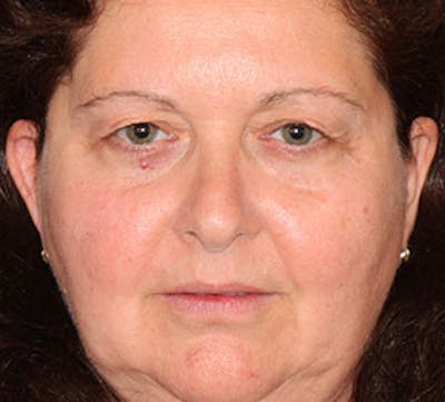 Browlift/Upper Blepharoplasty Before & After Gallery - Patient 106568850 - Image 1
