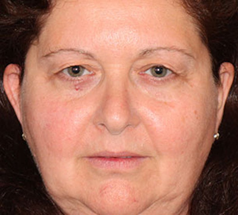 Browlift/Upper Blepharoplasty Before & After Gallery - Patient 106568850 - Image 1