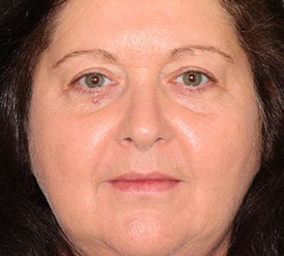 Browlift/Upper Blepharoplasty Before & After Gallery - Patient 106568850 - Image 2
