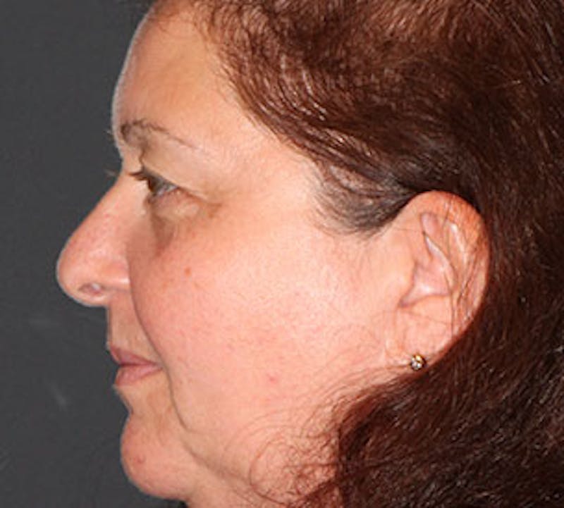 Browlift/Upper Blepharoplasty Before & After Gallery - Patient 106568850 - Image 9