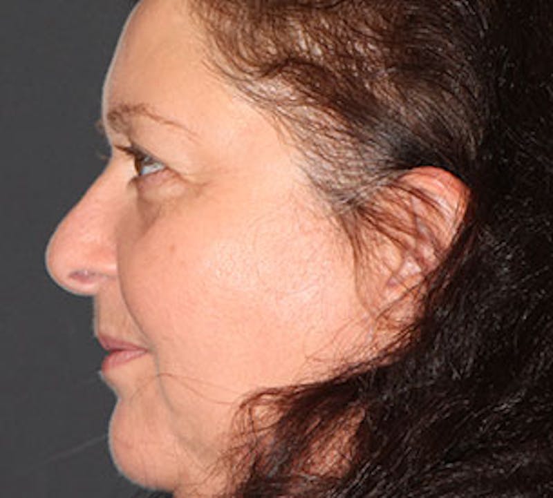 Browlift/Upper Blepharoplasty Before & After Gallery - Patient 106568850 - Image 10