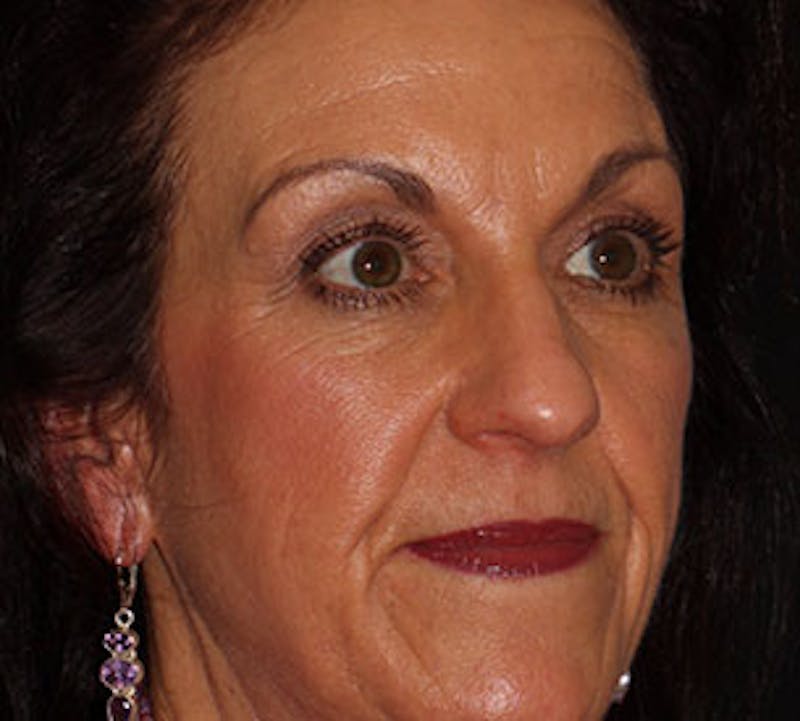 Browlift/Upper Blepharoplasty Before & After Gallery - Patient 106568854 - Image 3