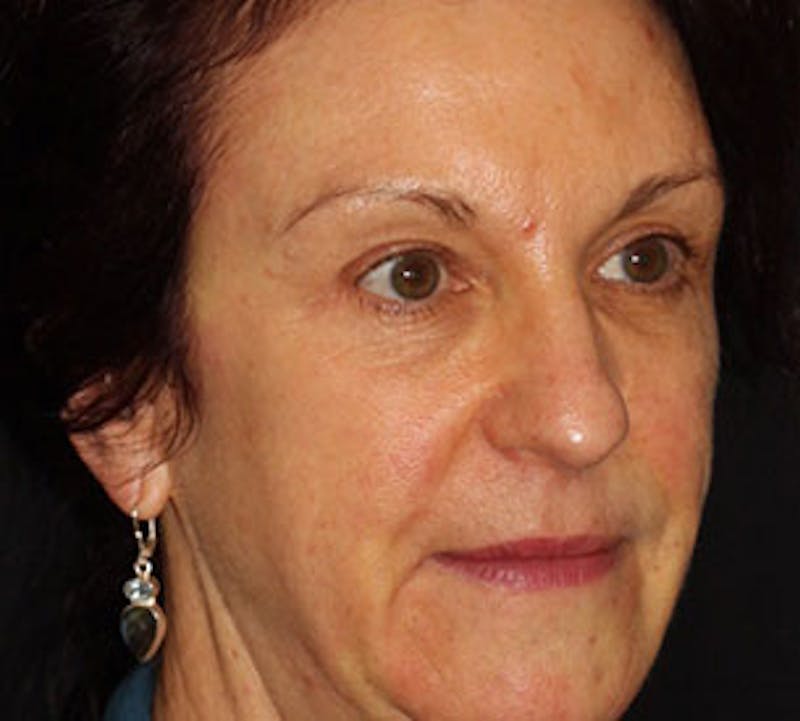 Browlift/Upper Blepharoplasty Before & After Gallery - Patient 106568854 - Image 4