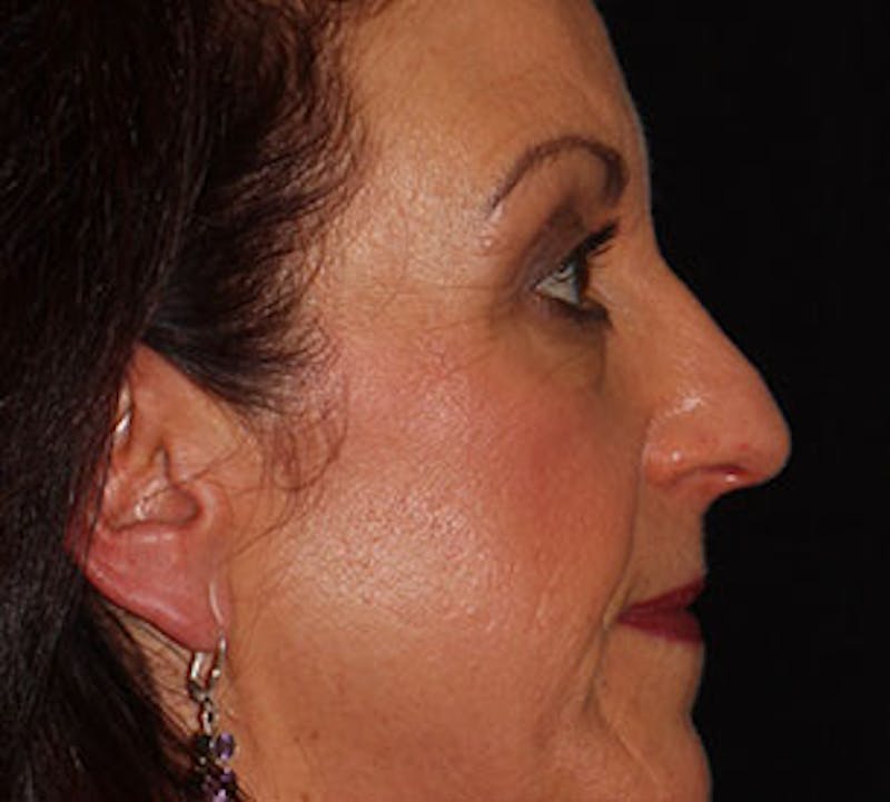 Browlift/Upper Blepharoplasty Before & After Gallery - Patient 106568854 - Image 7