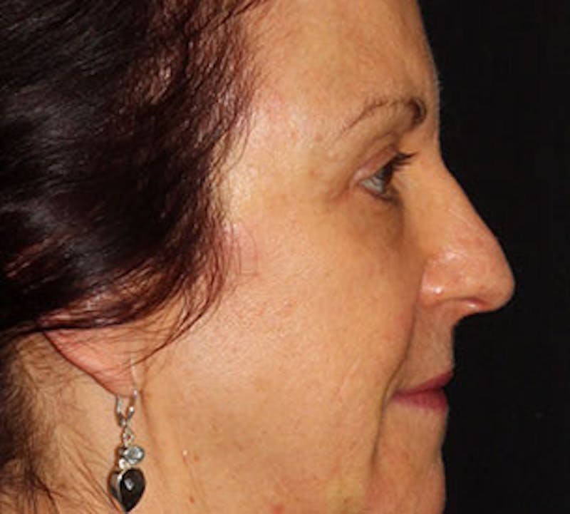 Browlift/Upper Blepharoplasty Before & After Gallery - Patient 106568854 - Image 8