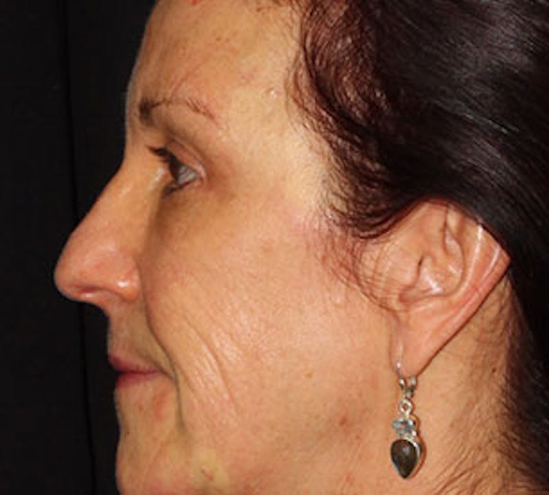 Browlift/Upper Blepharoplasty Before & After Gallery - Patient 106568854 - Image 10