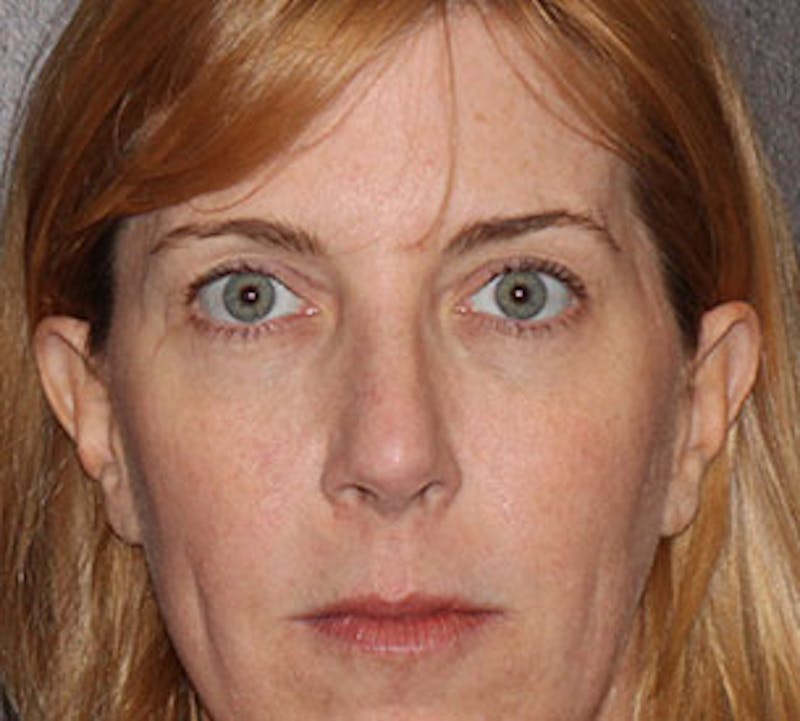 Browlift/Upper Blepharoplasty Before & After Gallery - Patient 106568857 - Image 1