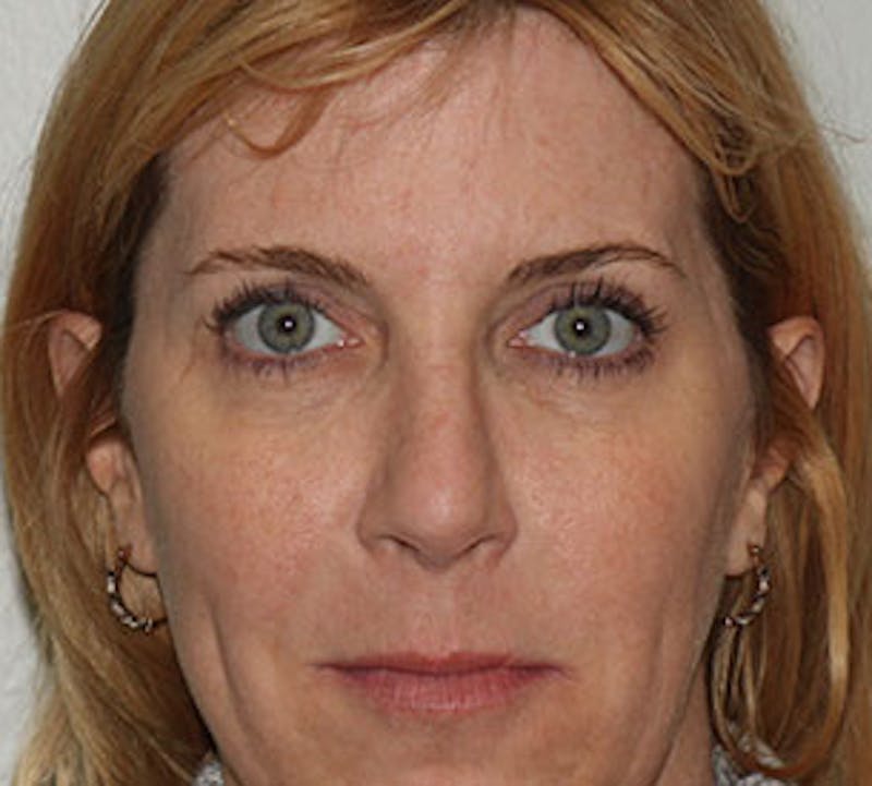 Browlift/Upper Blepharoplasty Before & After Gallery - Patient 106568857 - Image 2