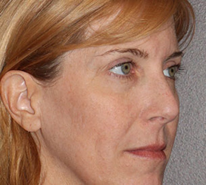 Browlift/Upper Blepharoplasty Before & After Gallery - Patient 106568857 - Image 3