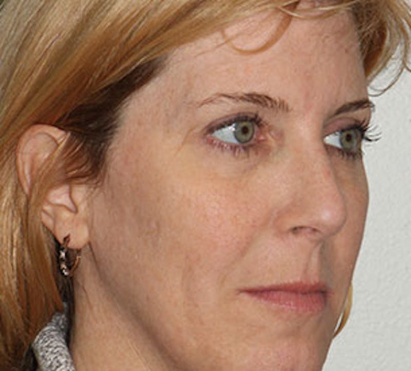 Browlift/Upper Blepharoplasty Before & After Gallery - Patient 106568857 - Image 4