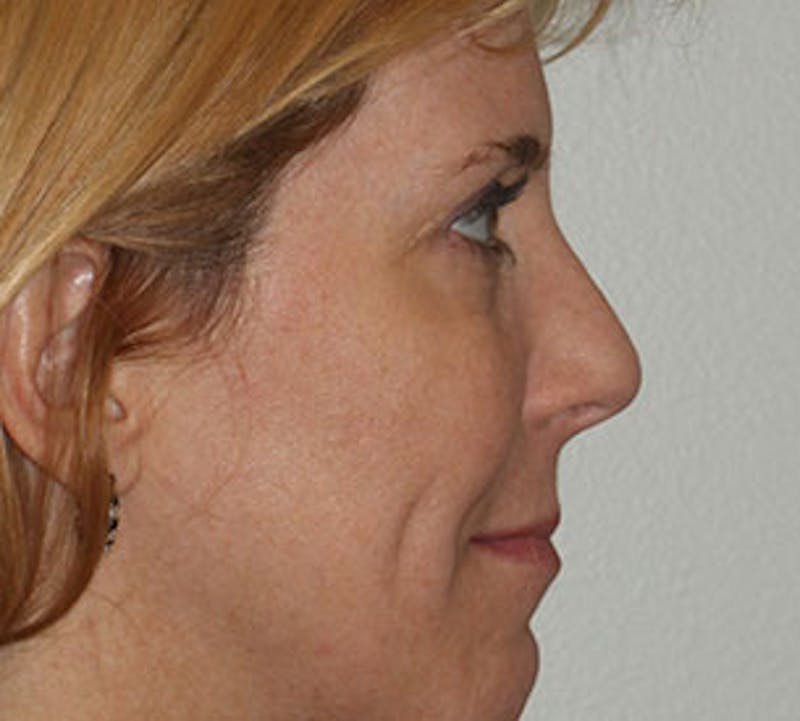 Browlift/Upper Blepharoplasty Before & After Gallery - Patient 106568857 - Image 8