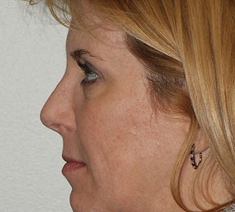 Browlift/Upper Blepharoplasty Before & After Gallery - Patient 106568857 - Image 10