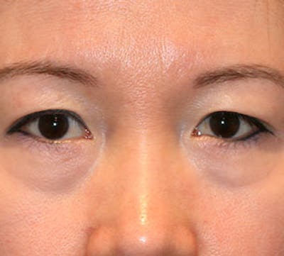 Lower Blepharoplasty Before & After Gallery - Patient 106569015 - Image 1