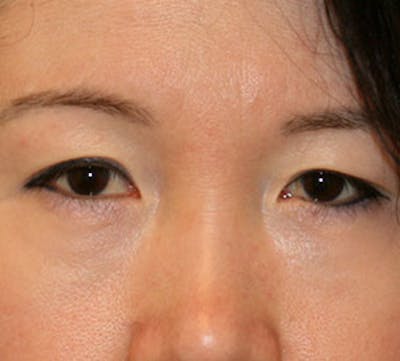Lower Blepharoplasty Before & After Gallery - Patient 106569015 - Image 2