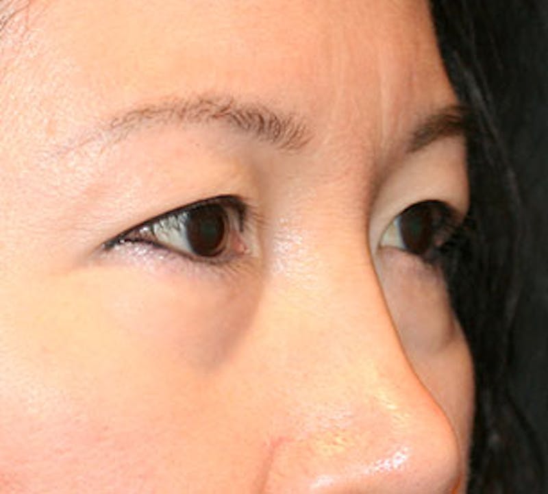 Lower Blepharoplasty Before & After Gallery - Patient 106569015 - Image 3