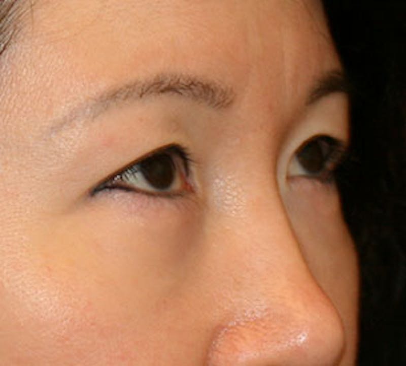 Lower Blepharoplasty Before & After Gallery - Patient 106569015 - Image 4