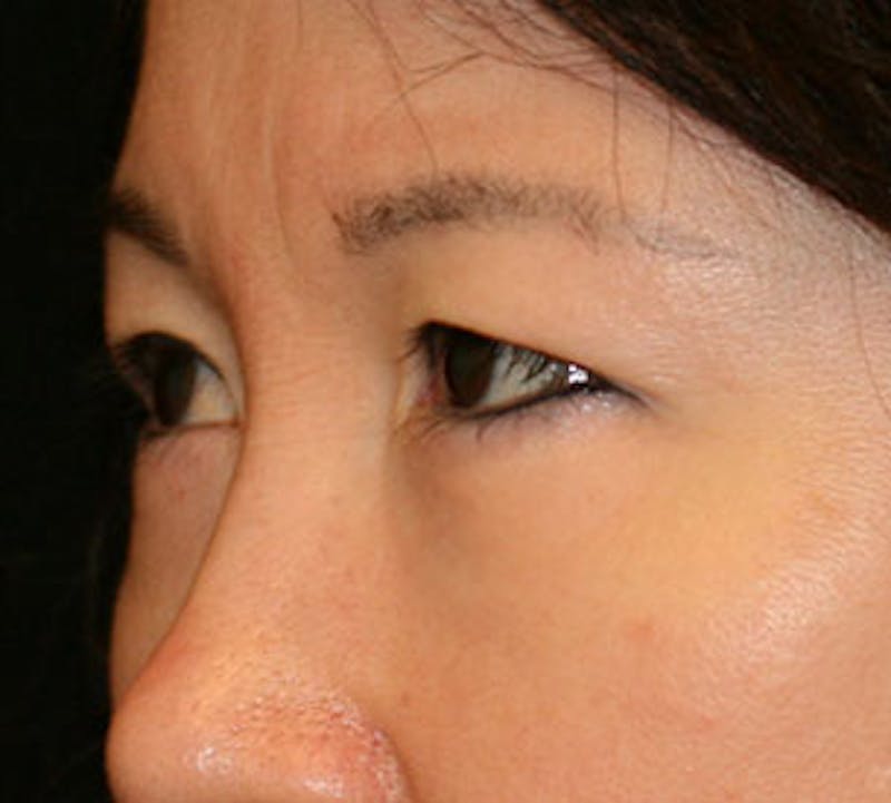 Lower Blepharoplasty Before & After Gallery - Patient 106569015 - Image 6