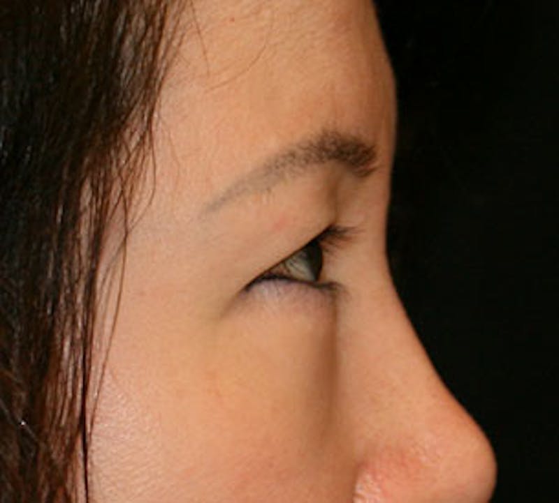 Lower Blepharoplasty Gallery - Patient 106569015 - Image 8