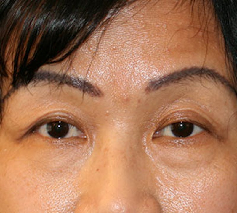 Lower Blepharoplasty Before & After Gallery - Patient 106569018 - Image 1