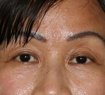 Lower Blepharoplasty Before & After Gallery - Patient 106569018 - Image 2