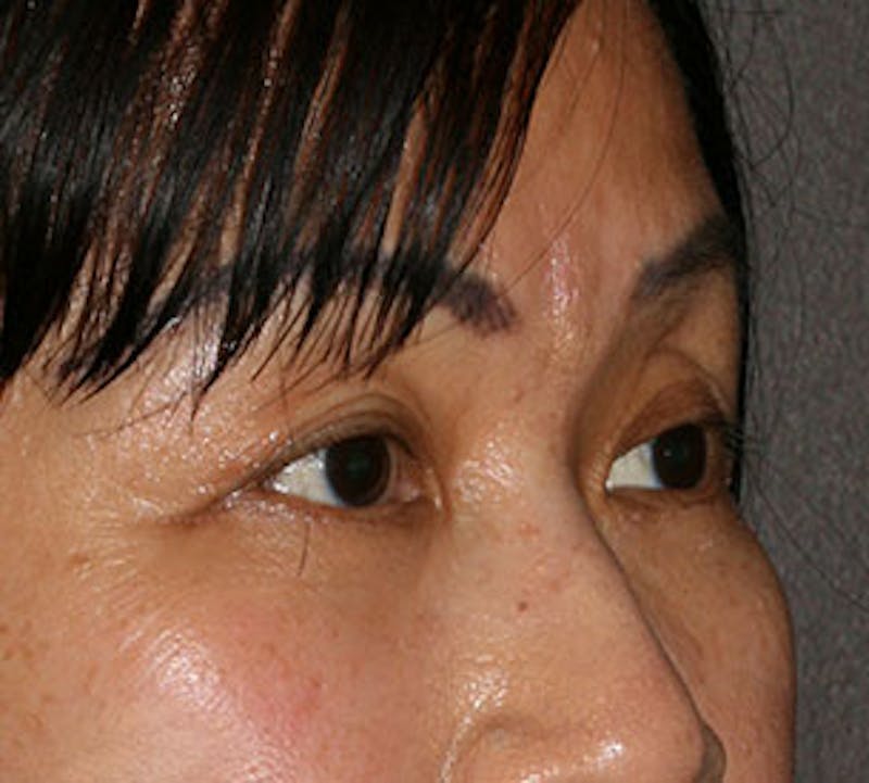 Lower Blepharoplasty Before & After Gallery - Patient 106569018 - Image 4